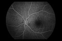 Retina, FA Late Stage