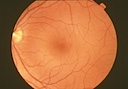 Retinal Photos