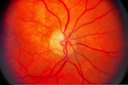 Retinal Bleeding I